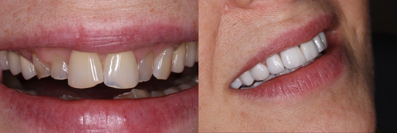 Visszakapni a mosolyod